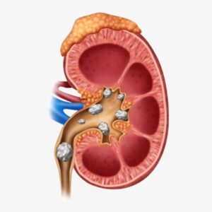 Cálculo renal: Como Prevenir Novas Crises